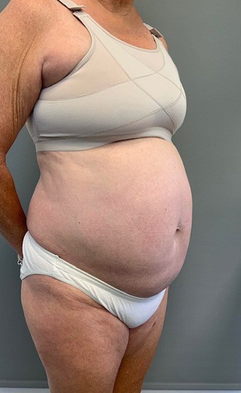 Before Image: Tummy Tuck (Abdominoplasty) - right-front-oblique