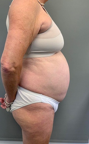 Before Image: Tummy Tuck (Abdominoplasty) - right-side