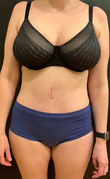 After Image: Tummy Tuck (Abdominoplasty) - front