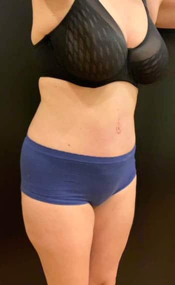 After Image: Tummy Tuck (Abdominoplasty) - right-front-oblique