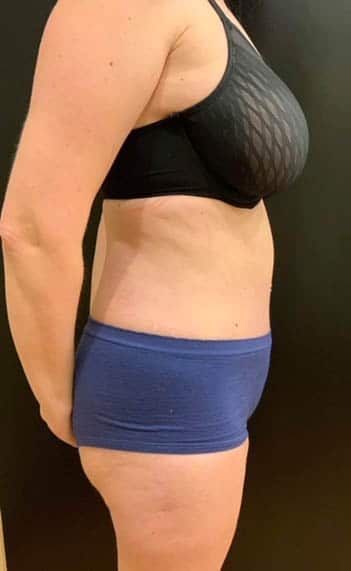 After Image: Tummy Tuck (Abdominoplasty) - right-side