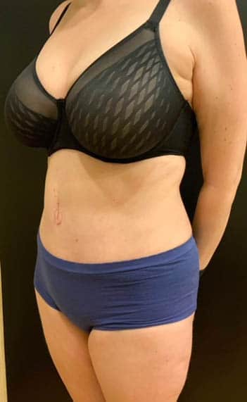 After Image: Tummy Tuck (Abdominoplasty) - left-front-oblique