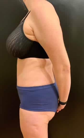 After Image: Tummy Tuck (Abdominoplasty) - left-side