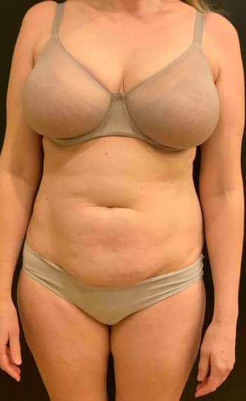 Before Image: Tummy Tuck (Abdominoplasty) - front