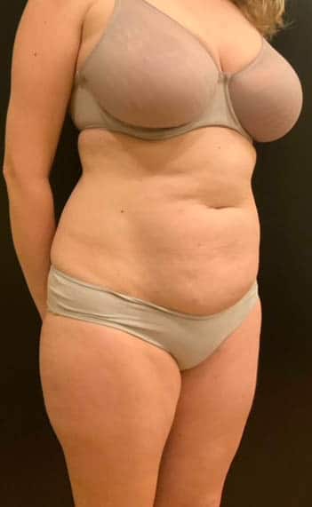 Before Image: Tummy Tuck (Abdominoplasty) - right-front-oblique