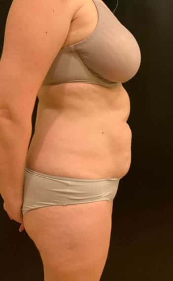 Before Image: Tummy Tuck (Abdominoplasty) - right-side