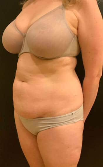 Before Image: Tummy Tuck (Abdominoplasty) - left-front-oblique