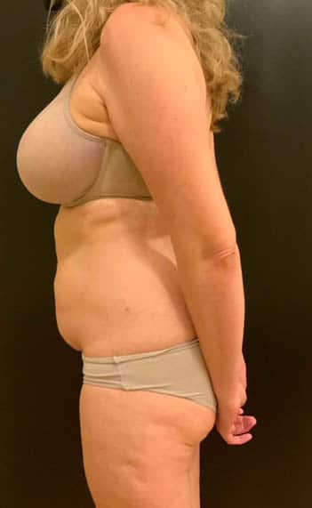 Before Image: Tummy Tuck (Abdominoplasty) - left-side