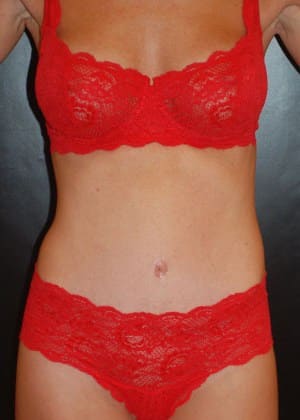 After Image: Tummy Tuck (Abdominoplasty) - front