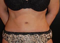 After Image: Tummy Tuck (Abdominoplasty) - front