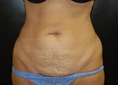 Before Image: Tummy Tuck (Abdominoplasty) - front