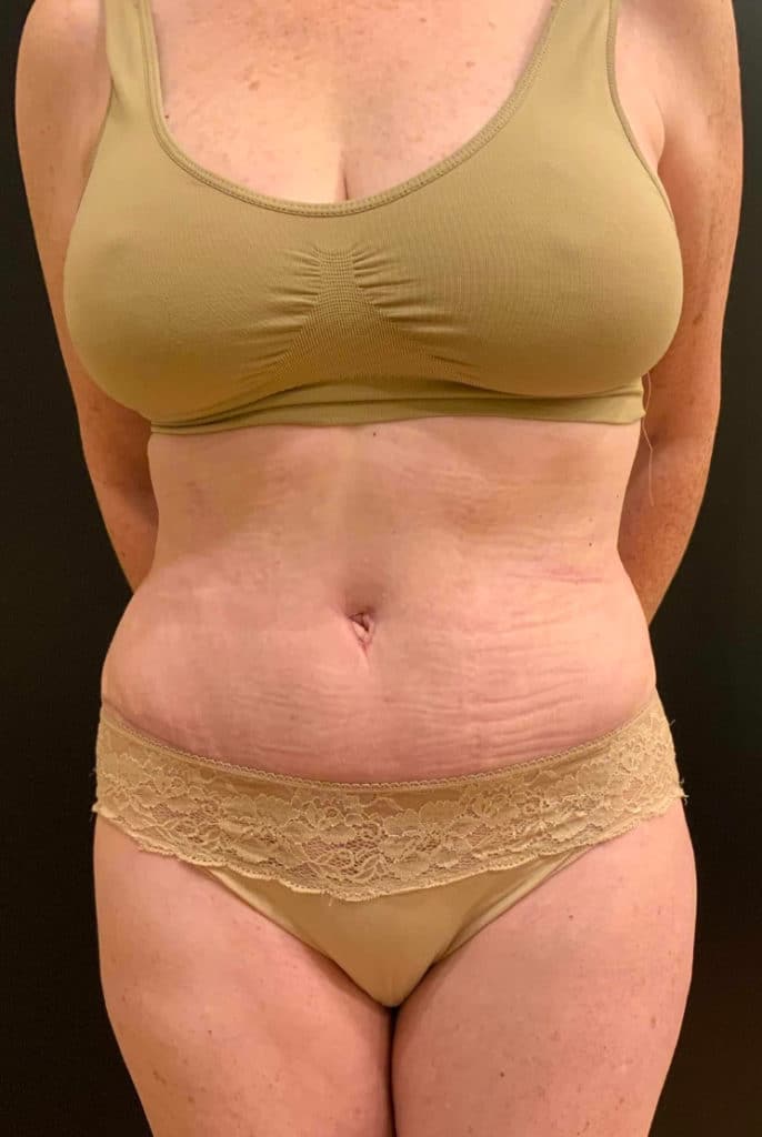 After Image: Tummy Tuck (Abdominoplasty) - front