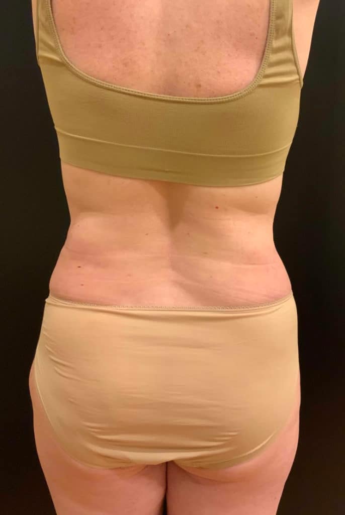 After Image: Tummy Tuck (Abdominoplasty) - back