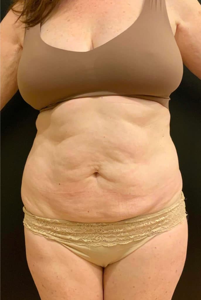 Before Image: Tummy Tuck (Abdominoplasty) - front