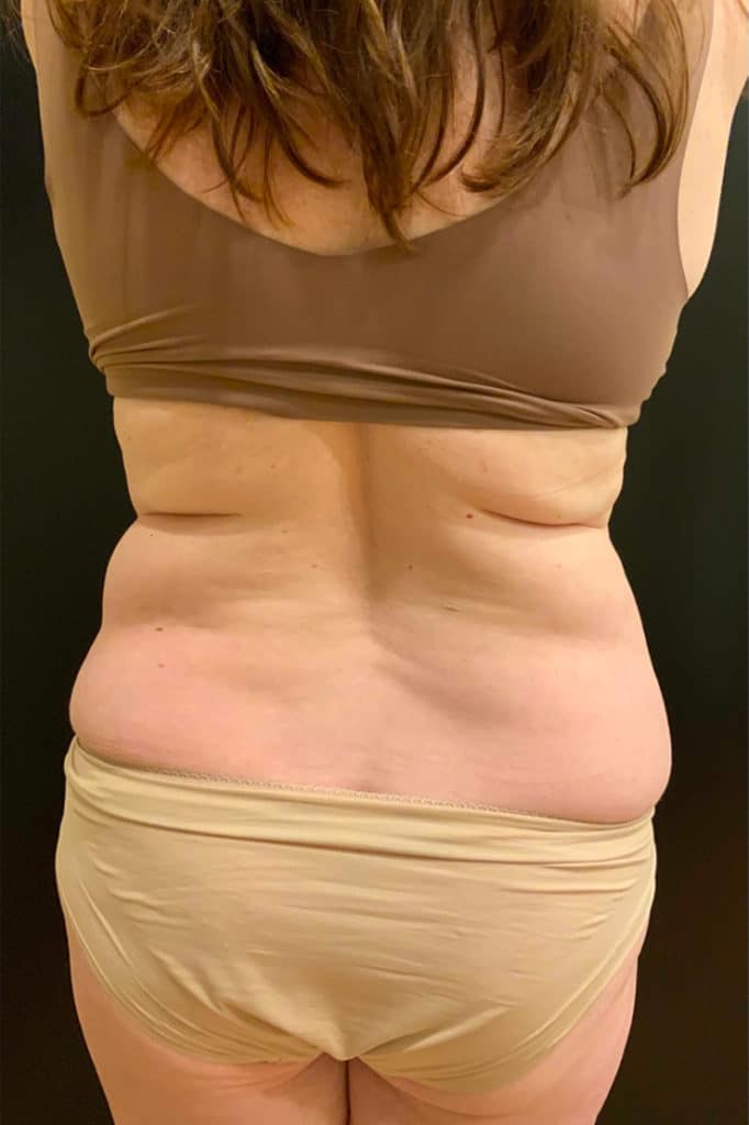 Before Image: Tummy Tuck (Abdominoplasty) - back