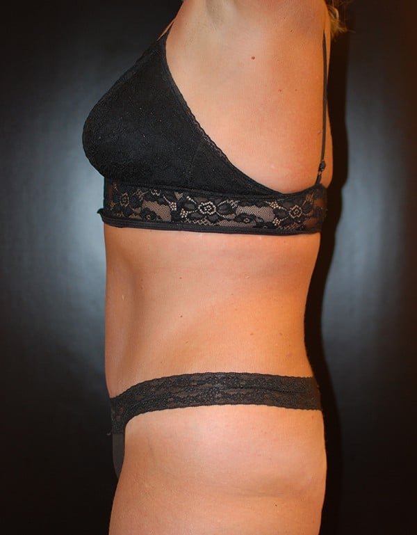After Image: Tummy Tuck (Abdominoplasty) - left-side