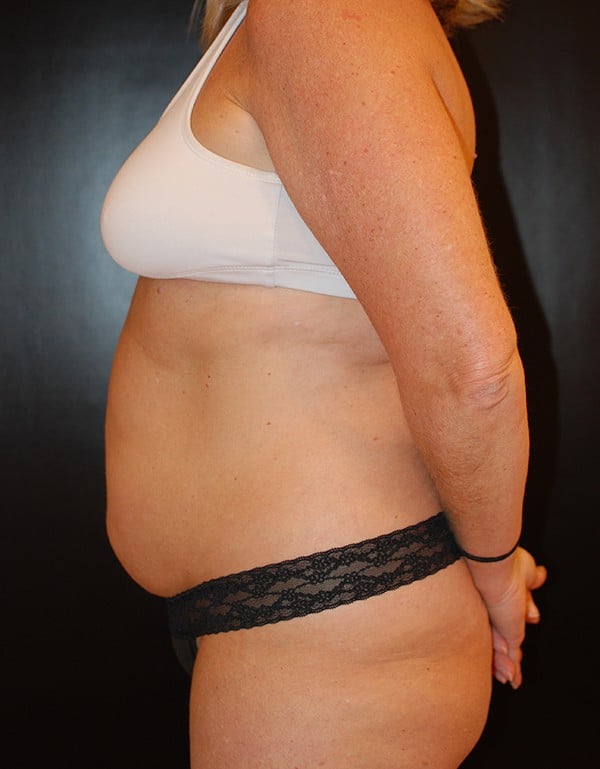 Before Image: Tummy Tuck (Abdominoplasty) - left-side