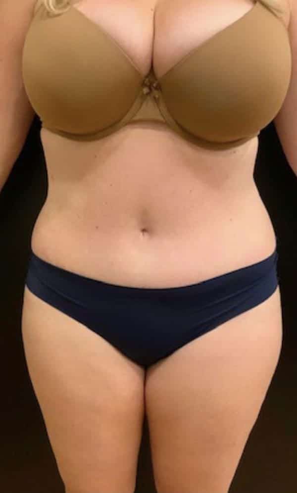 After Image: Tummy Tuck (Abdominoplasty) - front