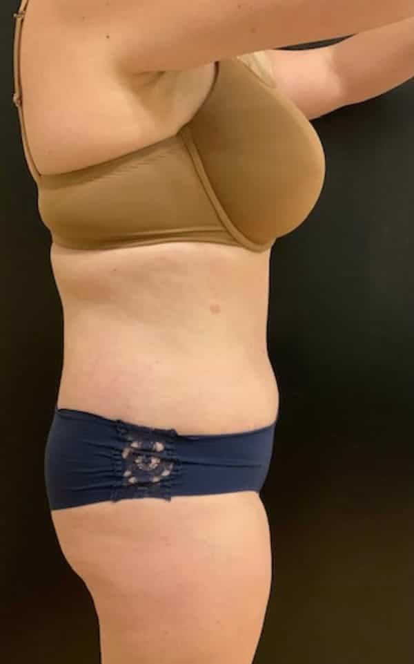 After Image: Tummy Tuck (Abdominoplasty) - right-side