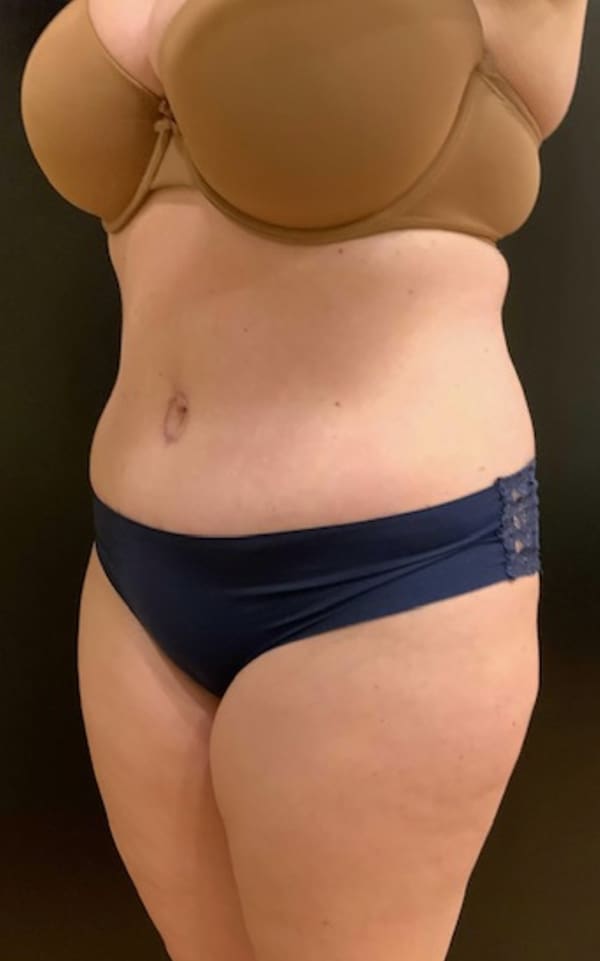 After Image: Tummy Tuck (Abdominoplasty) - left-front-oblique