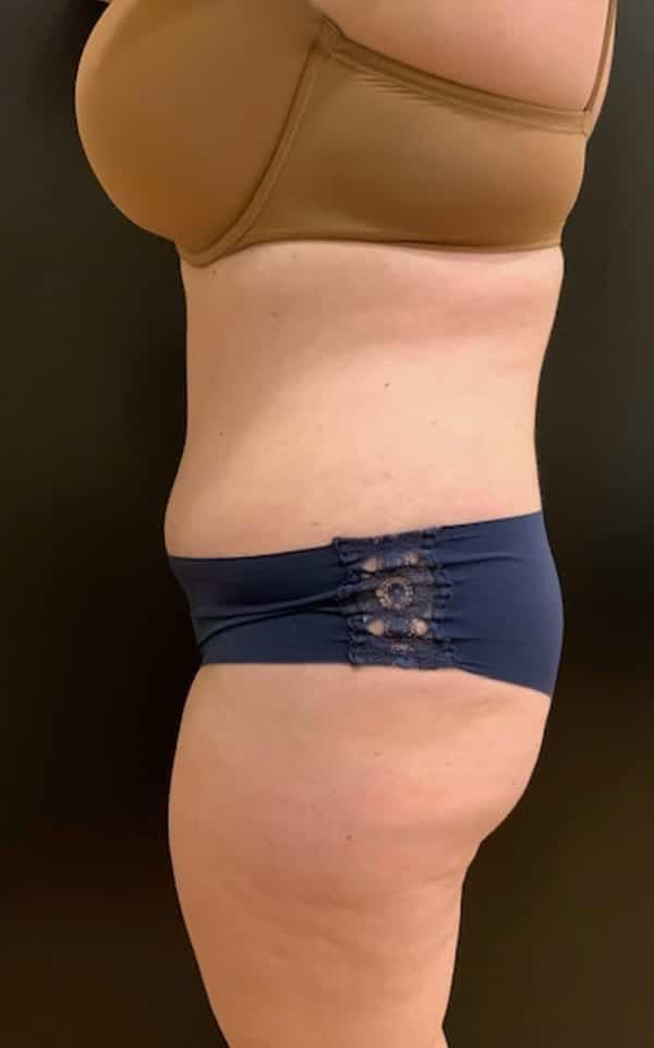After Image: Tummy Tuck (Abdominoplasty) - left-side