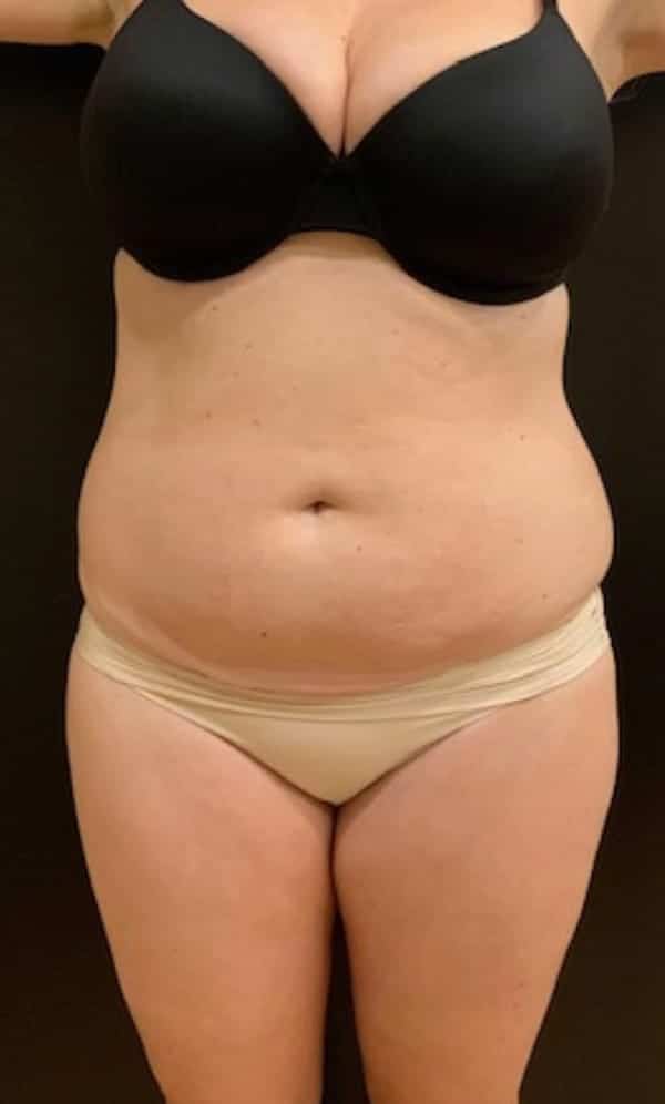 Before Image: Tummy Tuck (Abdominoplasty) - front