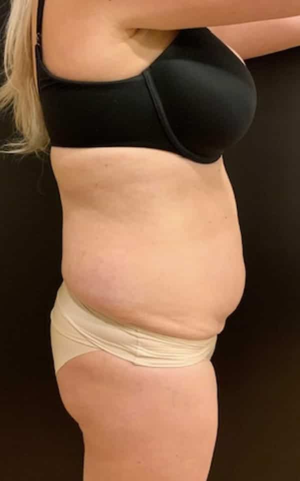 Before Image: Tummy Tuck (Abdominoplasty) - right-side