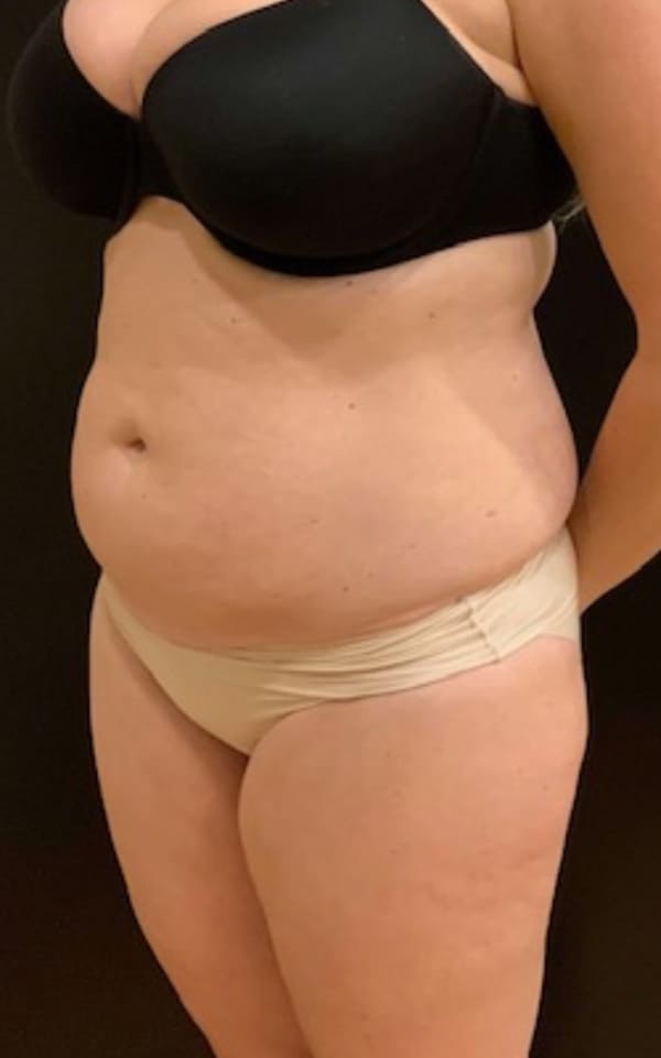 Before Image: Tummy Tuck (Abdominoplasty) - left-front-oblique
