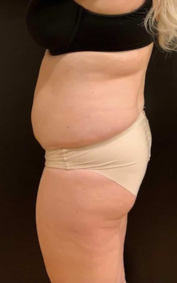 Before Image: Tummy Tuck (Abdominoplasty) - left-side