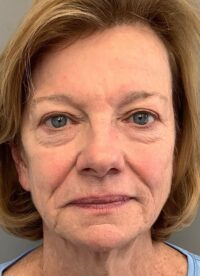 Blepharoplasty