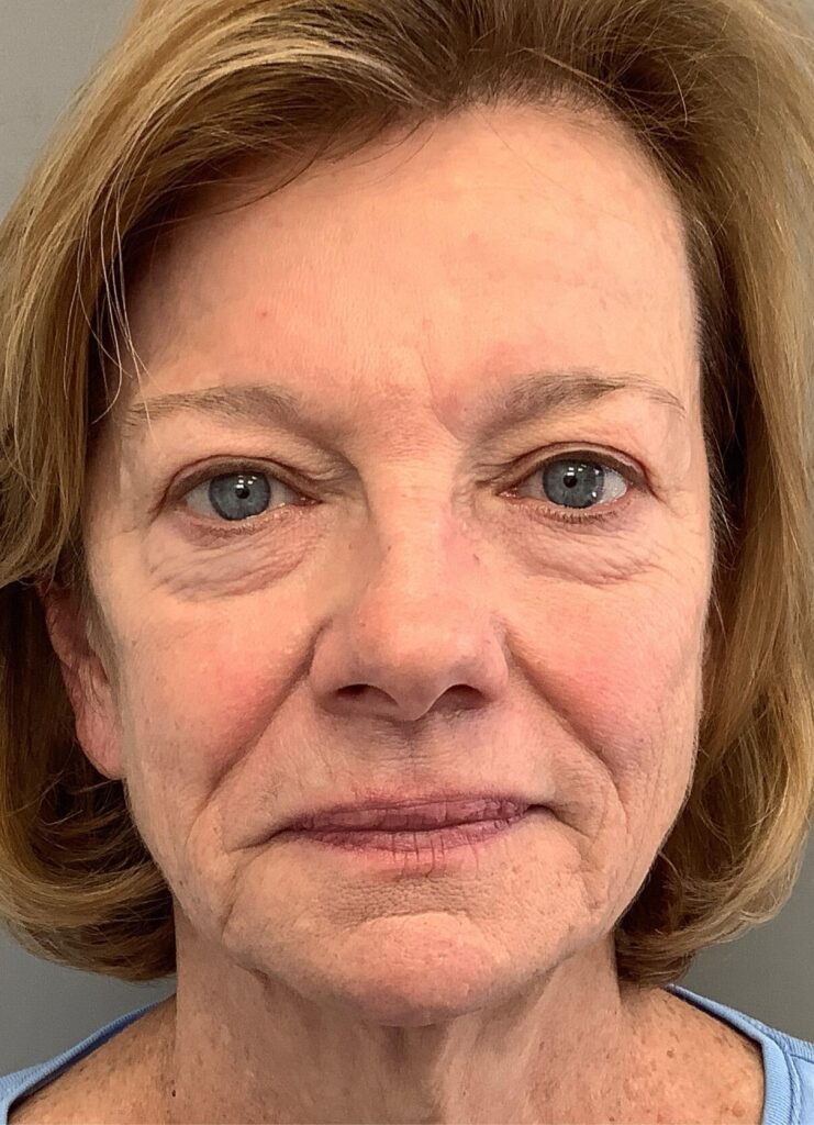 Blepharoplasty