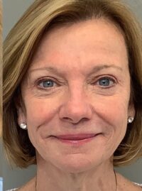 Blepharoplasty