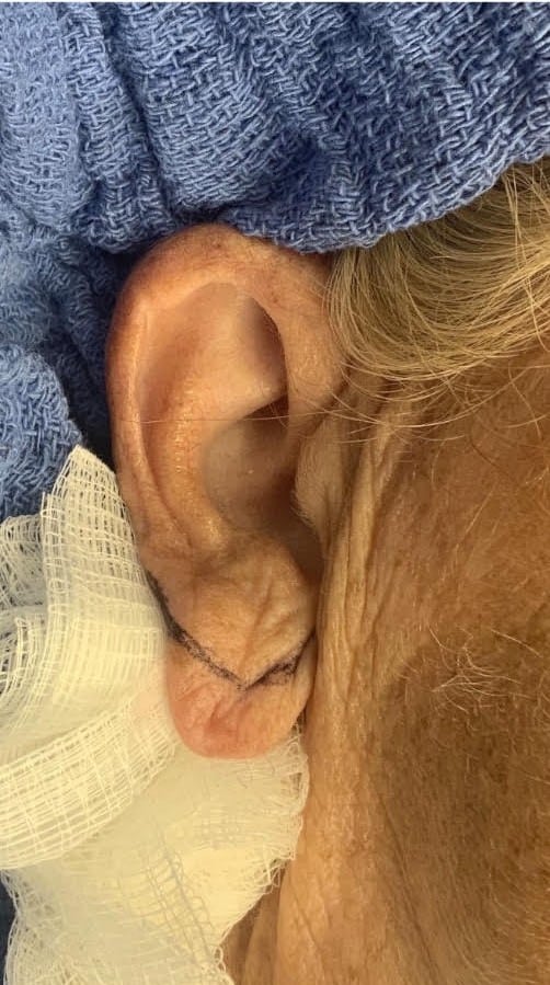 Earlobe Repair/Reduction