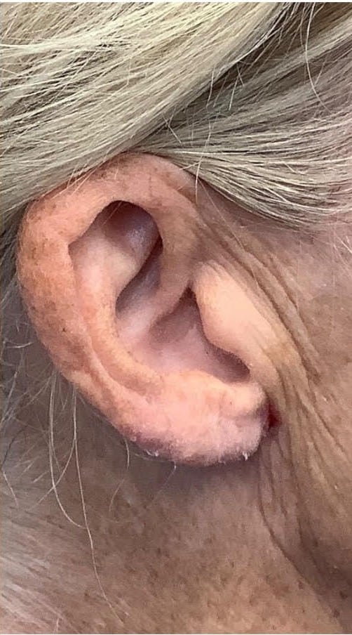 Earlobe Repair/Reduction
