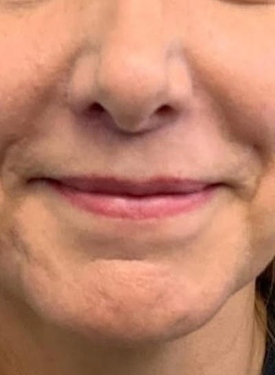 Lip Lift