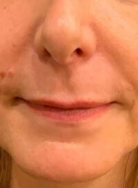 Lip Lift