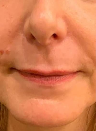 Lip Lift
