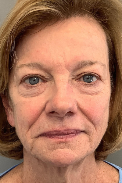 Before Image: Blepharoplasty & PRFM injections - front