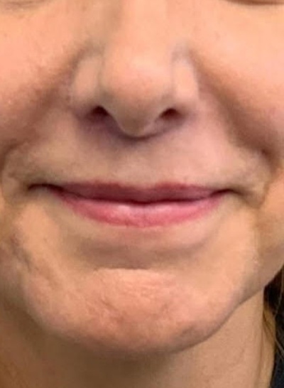 After Image: Lip Lift - front